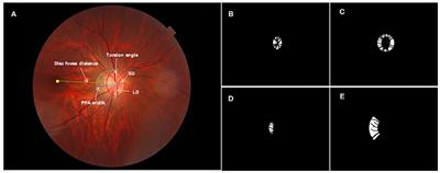 Imaging Features by Machine Learning for Quantification of Optic Disc Changes and Impact on Choroidal Thickness in Young Myopic Patients